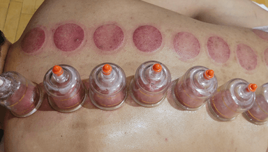 Image for 60 Dynamic Cupping therapy