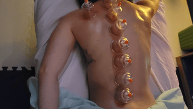 Image for 30 Dynamic Cupping therapy